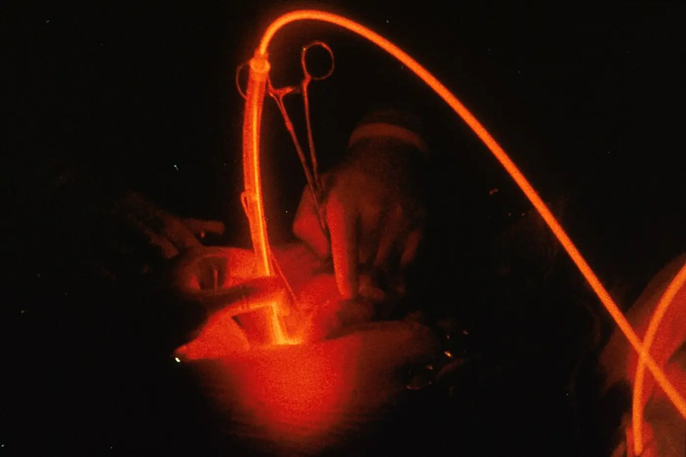 A glowing red optical fibre delivering light during a hospital photodynamic therapy procedure