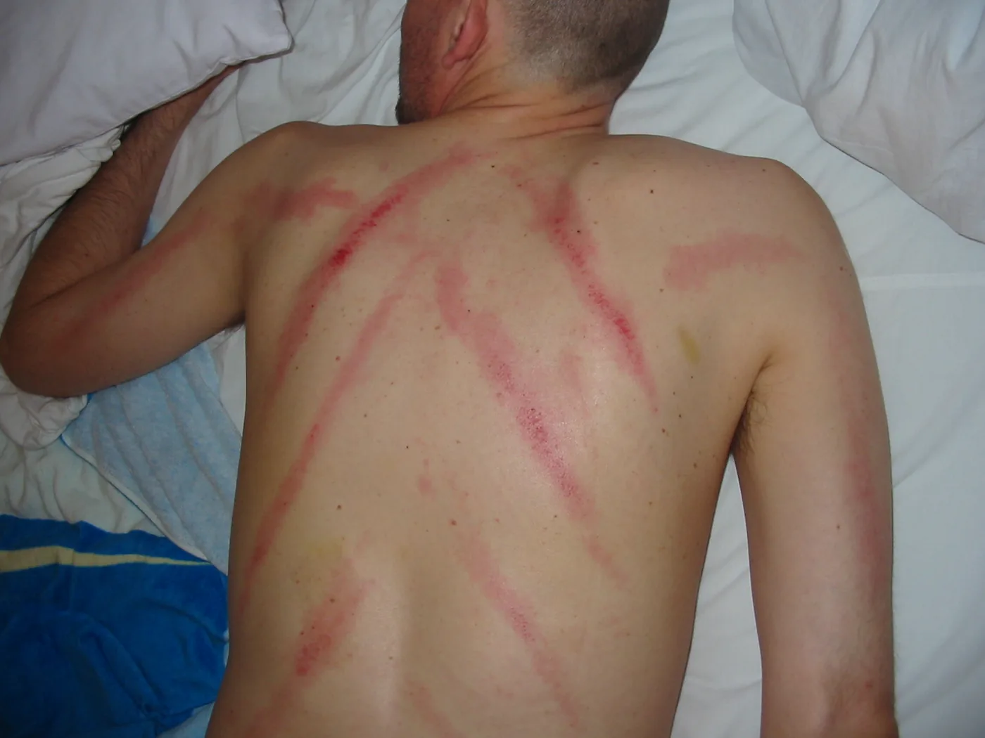 A man lying face down on a bed with red linear scraping marks running diagonally across his upper back and shoulders
