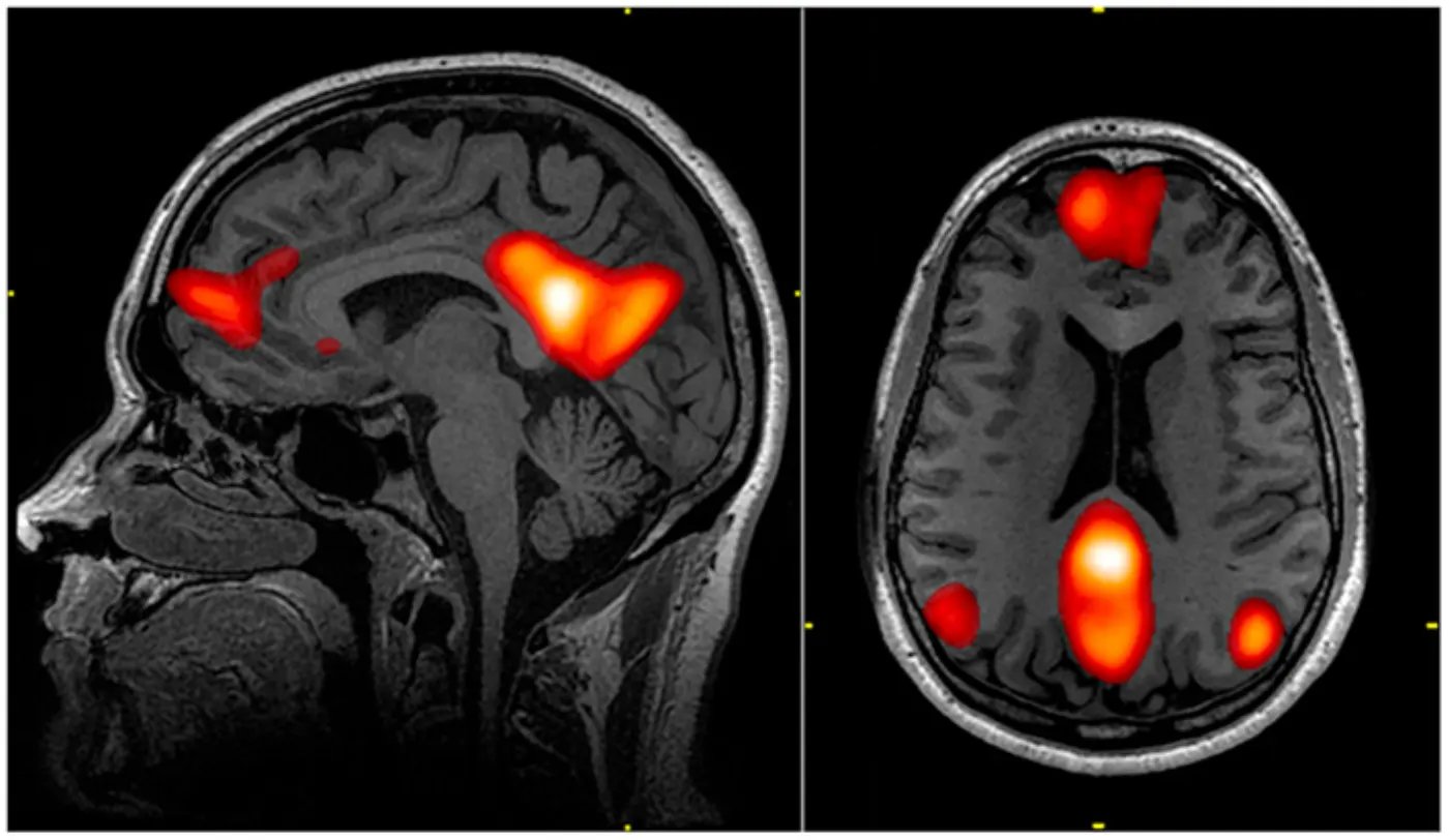 Brain MRI scans with orange and red areas marking regions of the default mode network