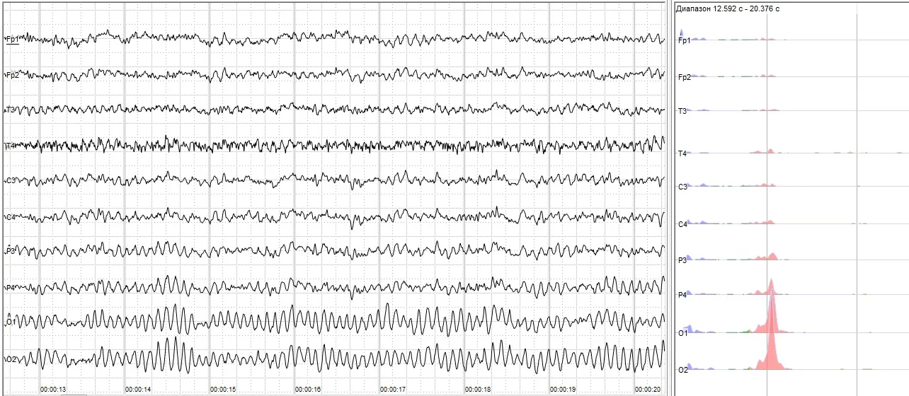 EEG chart with several channels showing regular alpha waves